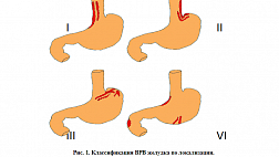 Классификация варикозно расширенных вен пищевода и желудка по Sarin, 1992 г.